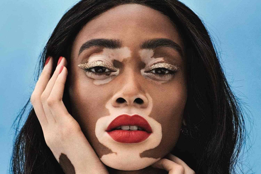 Le vitiligo @sohealthy.fr