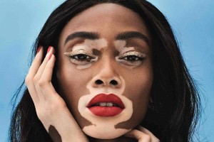Le vitiligo @sohealthy.fr