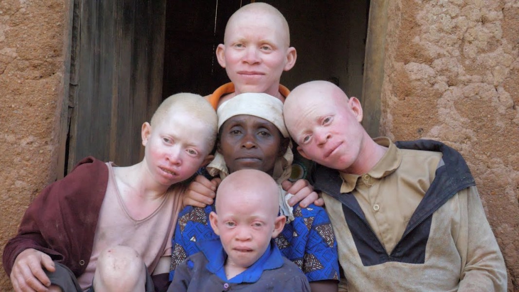 L'albinisme est une affection gÃ©nÃ©tique hÃ©rÃ©ditaire qui cause une absence totale de pigmentation de la peau, des cheveux et des yeux.
