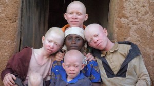 L'albinisme est une affection génétique héréditaire qui cause une absence totale de pigmentation de la peau, des cheveux et des yeux.