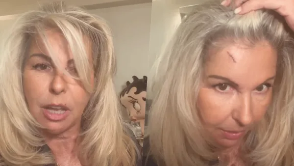 Affaire conclue : Caroline Margeridon fait une lourde chut sur un escalier et se retrouve avec une énorme entaille au visage